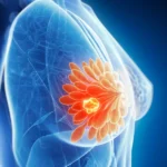 Breast Lump